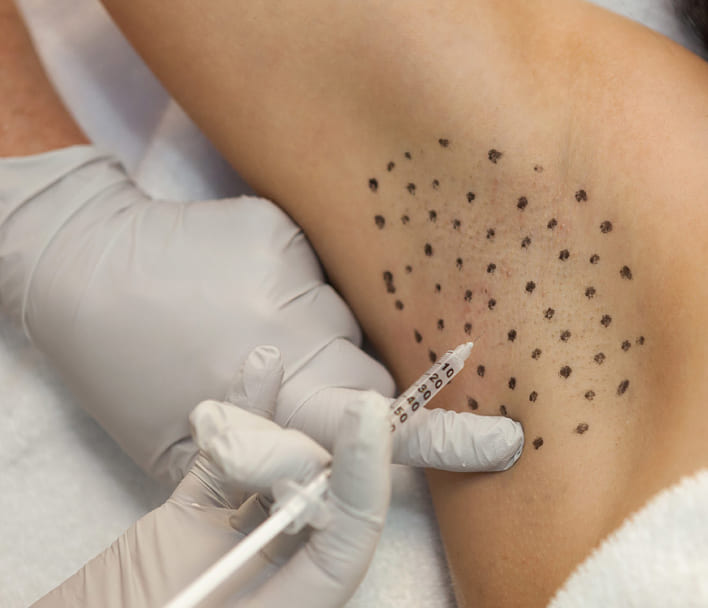 Hyperhidrosis Treatment (Excessive Sweating) at Phoenix Cosmetic Centre